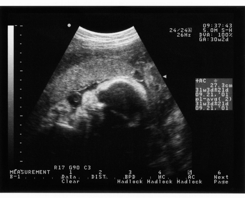 Pink/brown discharge at 5 weeks pregnant