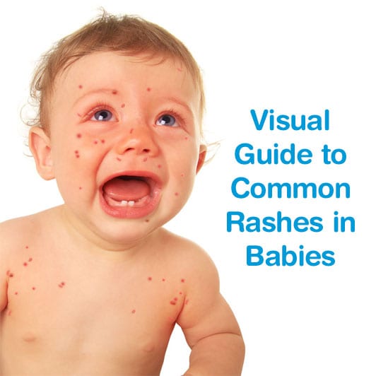 Newborn Rash On Face